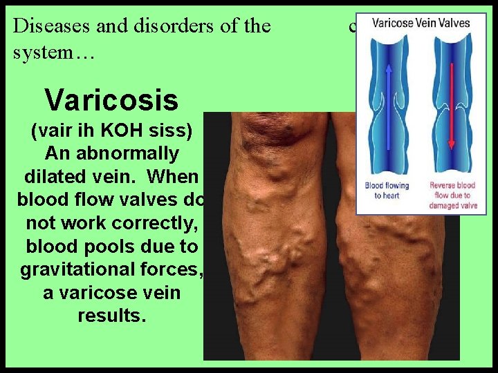 Diseases and disorders of the system… Varicosis (vair ih KOH siss) An abnormally dilated