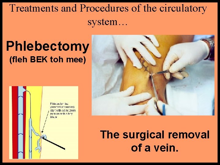 Treatments and Procedures of the circulatory system… Phlebectomy (fleh BEK toh mee) The surgical