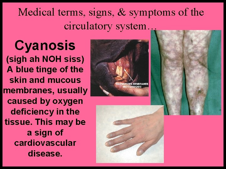 Medical terms, signs, & symptoms of the circulatory system… Cyanosis (sigh ah NOH siss)