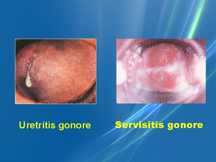 Uretritis gonore Servisitis gonore 
