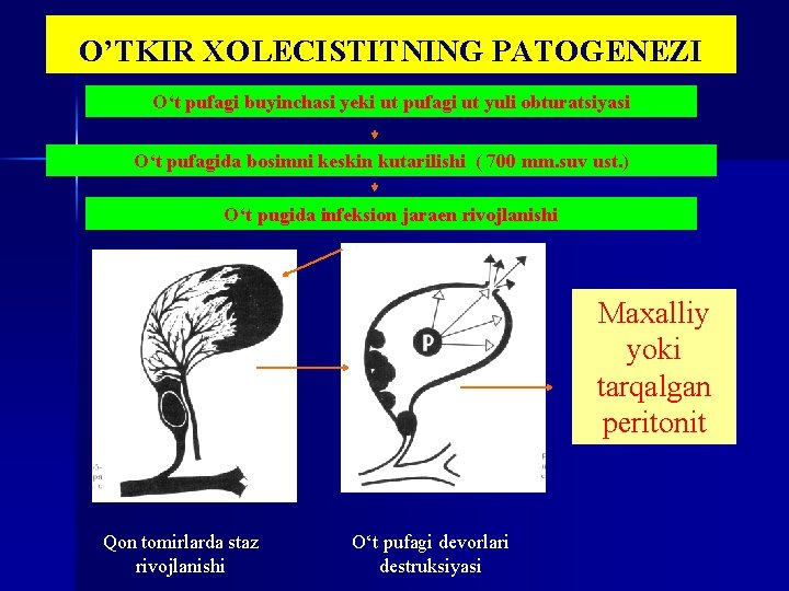 O’TKIR XOLECISTITNING PATOGENEZI O‘t pufagi buyinchasi yeki ut pufagi ut yuli obturatsiyasi O‘t pufagida