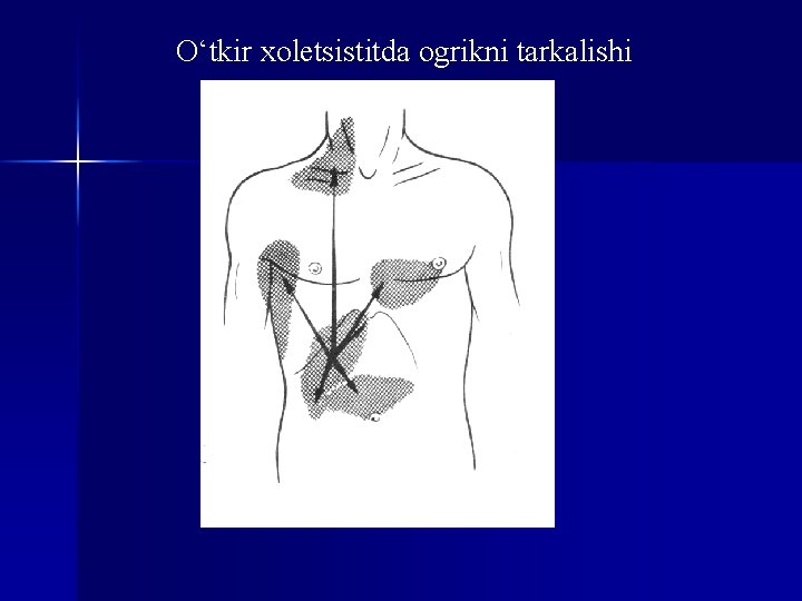 O‘tkir xoletsistitda ogrikni tarkalishi 