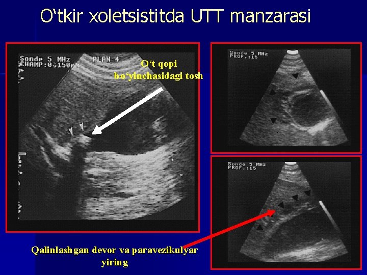 O‘tkir xoletsistitda UTT manzarasi O‘t qopi bo‘yinchasidagi tosh Qalinlashgan devor va paravezikulyar yiring 