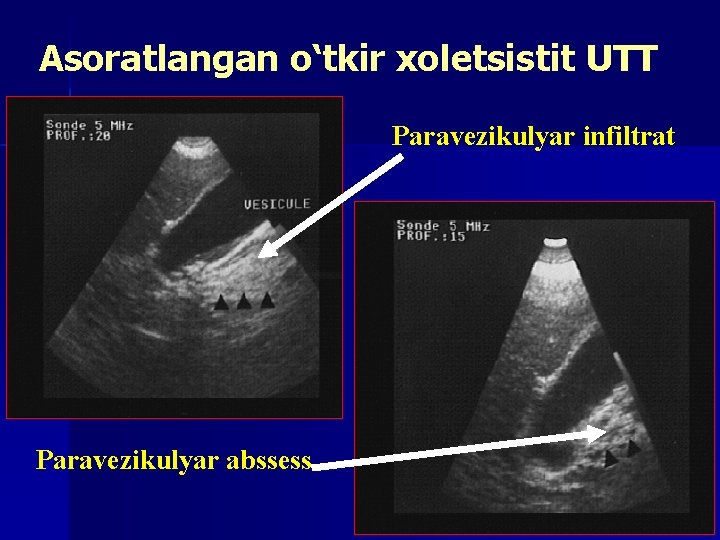 Asoratlangan o‘tkir xoletsistit UTT Paravezikulyar infiltrat Paravezikulyar abssess 