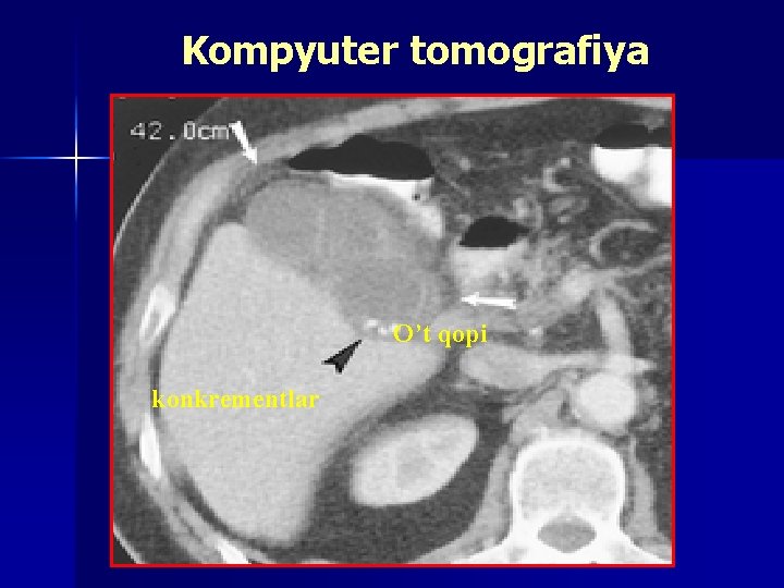 Kompyuter tomografiya O’t qopi konkrementlar 