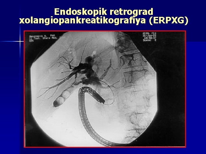 Endoskopik retrograd xolangiopankreatikografiya (ERPXG) 