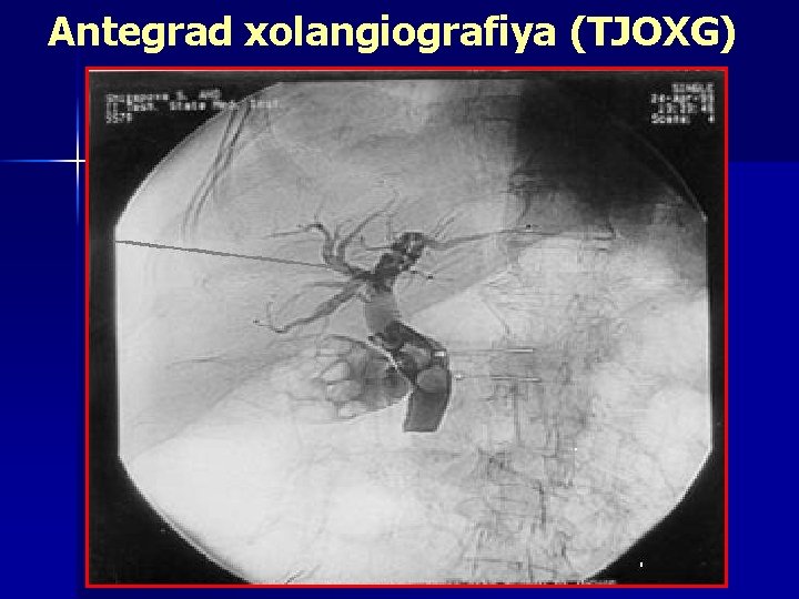 Antegrad xolangiografiya (TJOXG) 