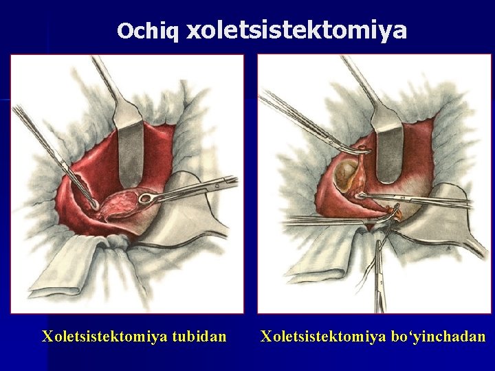 Ochiq xoletsistektomiya Xoletsistektomiya tubidan Xoletsistektomiya bo‘yinchadan 