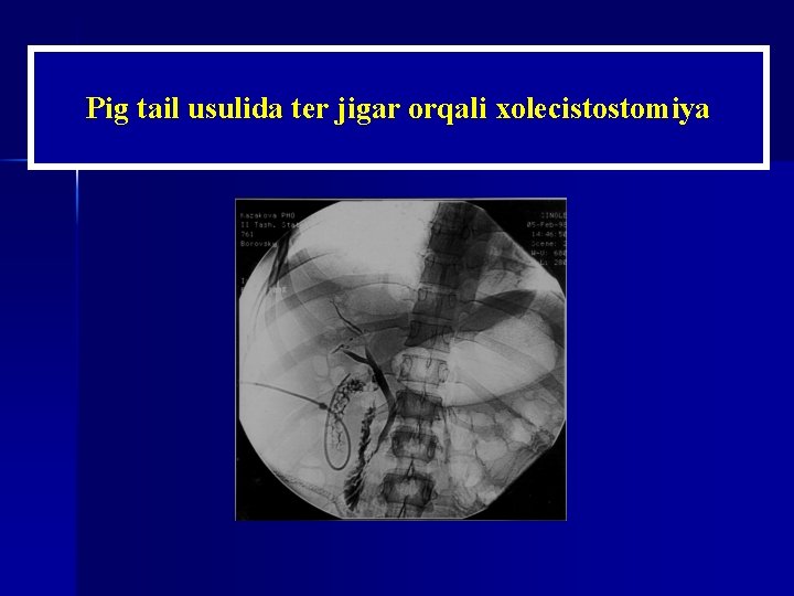 Рig tail usulida ter jigar orqali xolecistostomiya 