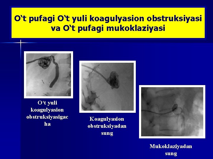 O‘t pufagi O‘t yuli koagulyasion obstruksiyasi va O‘t pufagi mukoklaziyasi O‘t yuli koagulyasion obstruksiyasigac