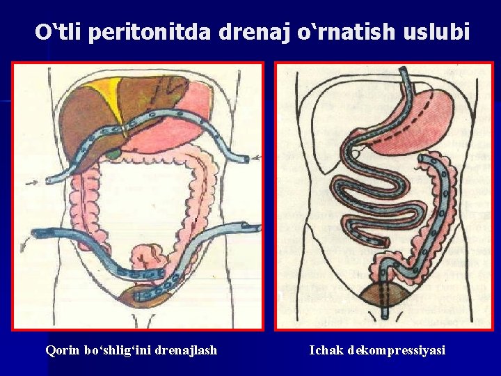 O‘tli peritonitda drenaj o‘rnatish uslubi Qorin bo‘shlig‘ini drenajlash Ichak dekompressiyasi 