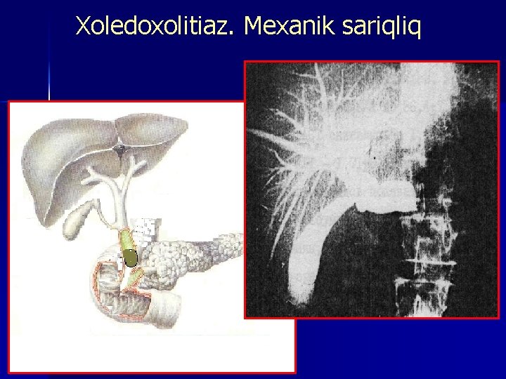 Xoledoxolitiaz. Mexanik sariqliq 