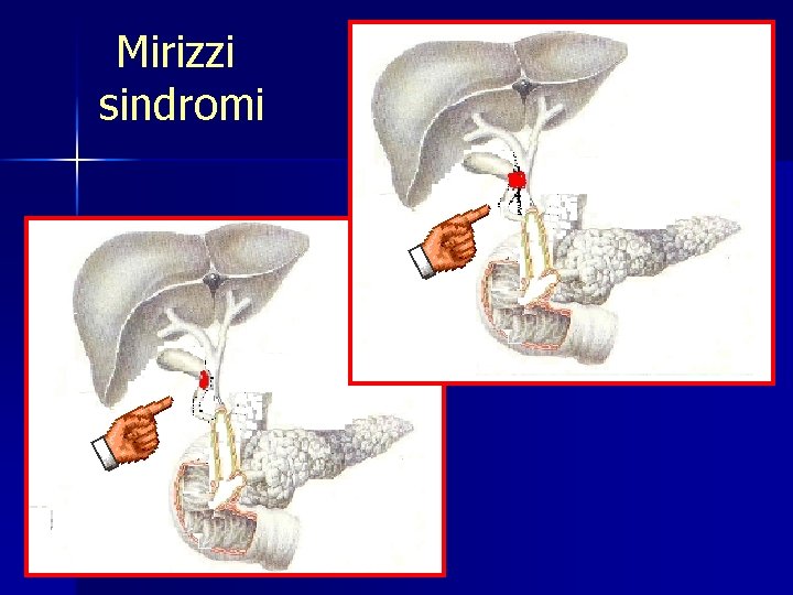 Mirizzi sindromi 