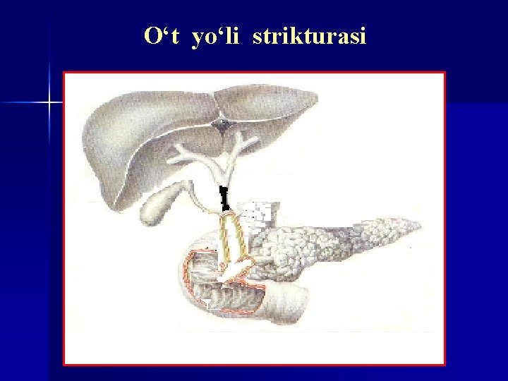 O‘t yo‘li strikturasi 