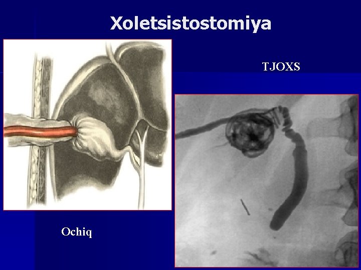 Xoletsistostomiya TJOXS Ochiq 