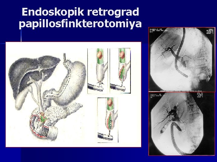 Endoskopik retrograd papillosfinkterotomiya 