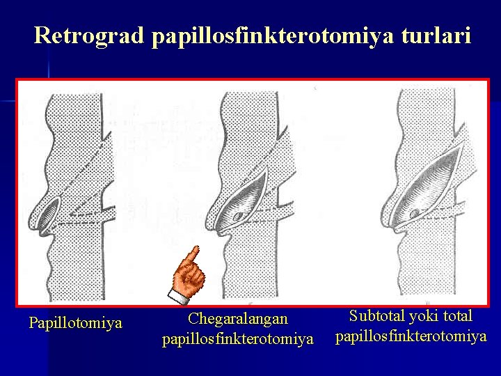 Retrograd papillosfinkterotomiya turlari Papillotomiya Chegaralangan papillosfinkterotomiya Subtotal yoki total papillosfinkterotomiya 