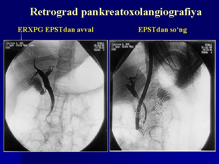 Retrograd pankreatoxolangiografiya ERXPG EPSTdan avval EPSTdan so‘ng 