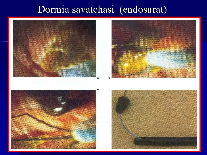 Dormia savatchasi (endosurat) 