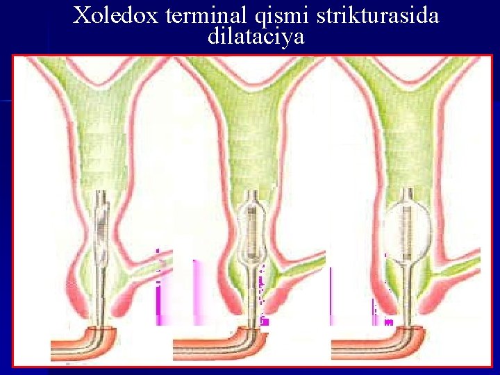 Xoledox terminal qismi strikturasida dilataciya 