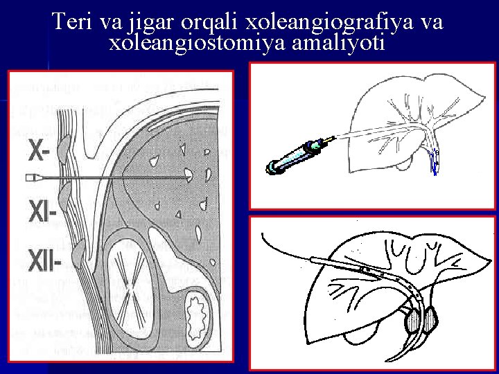 Teri va jigar orqali xoleangiografiya va xoleangiostomiya amaliyoti 