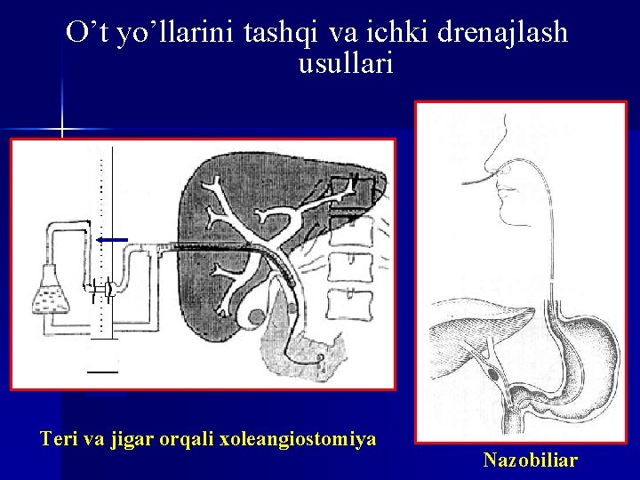 O’t yo’llarini tashqi va ichki drenajlash usullari Teri va jigar orqali xoleangiostomiya Nazobiliar 