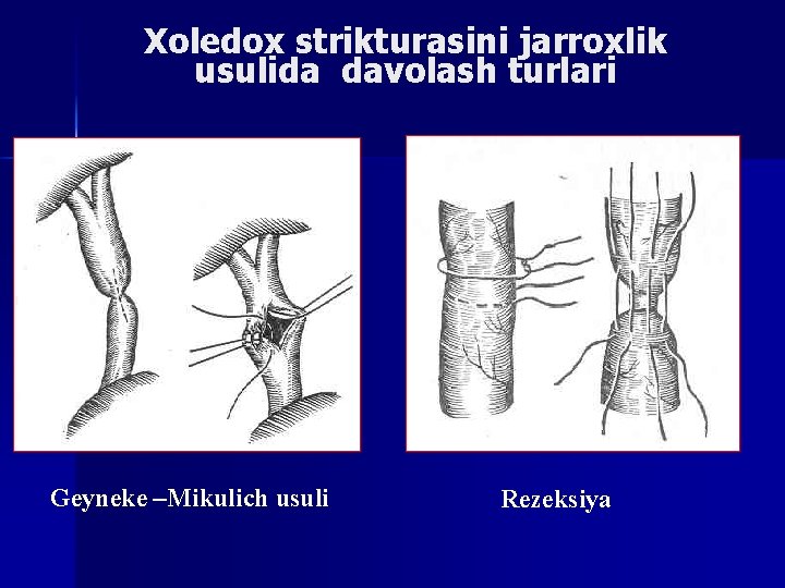 Xoledox strikturasini jarroxlik usulida davolash turlari Geyneke –Mikulich usuli Rezeksiya 