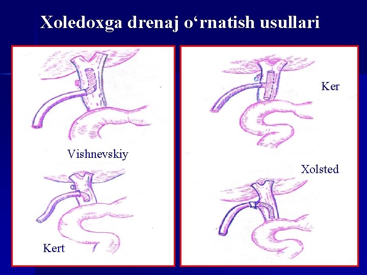 Xoledoxga drenaj o‘rnatish usullari n. Ker n n. Vishnevskiy n. Xolsted Kert 