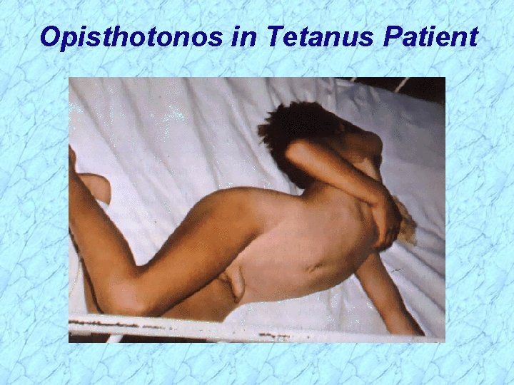 Opisthotonos in Tetanus Patient 