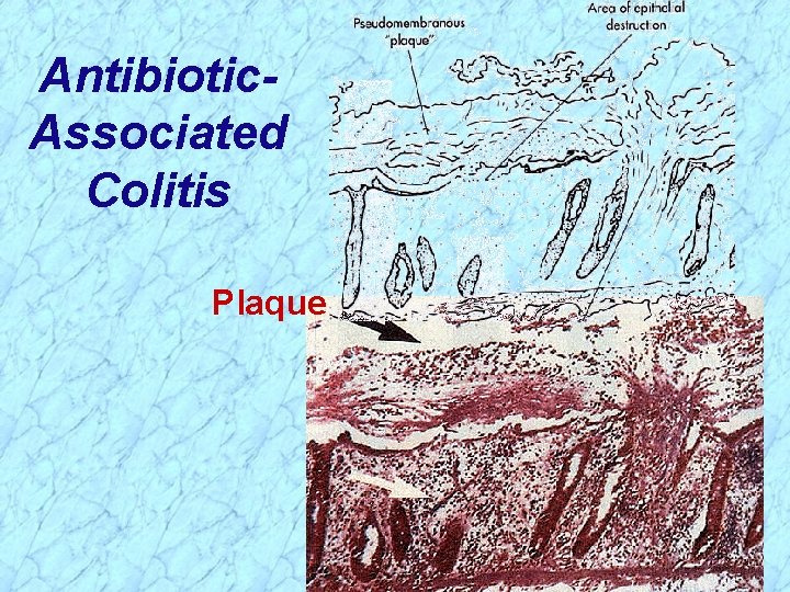 Antibiotic. Associated Colitis Plaque 