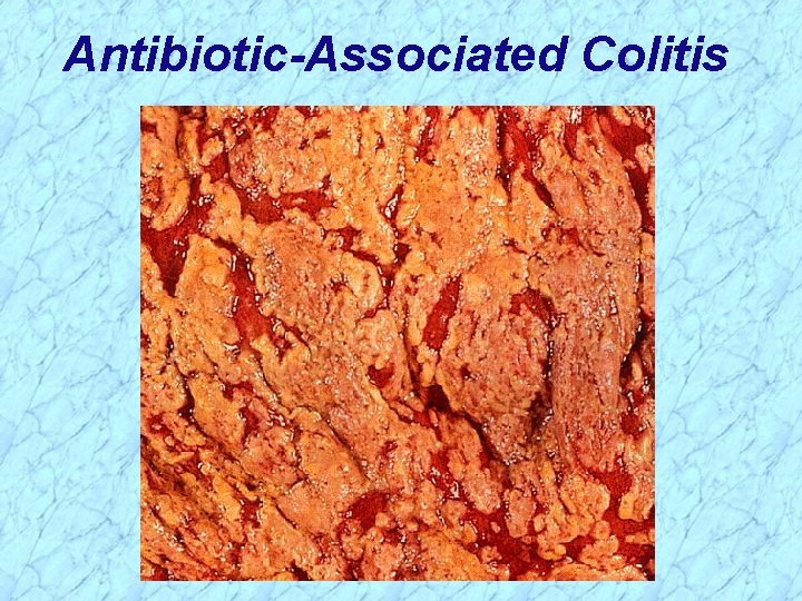 Antibiotic-Associated Colitis 