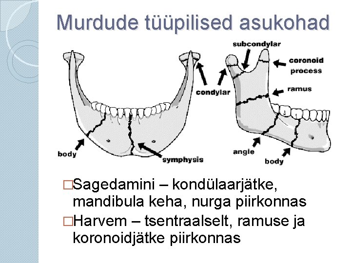 Murdude tüüpilised asukohad �Sagedamini – kondülaarjätke, mandibula keha, nurga piirkonnas �Harvem – tsentraalselt, ramuse