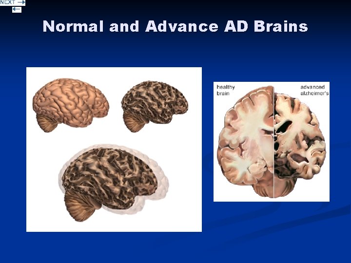 Normal and Advance AD Brains 