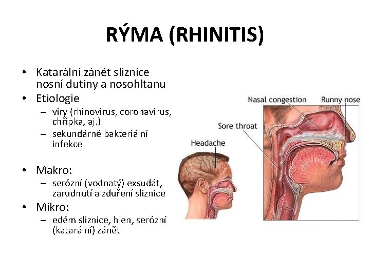 RÝMA (RHINITIS) • Katarální zánět sliznice nosní dutiny a nosohltanu • Etiologie – viry