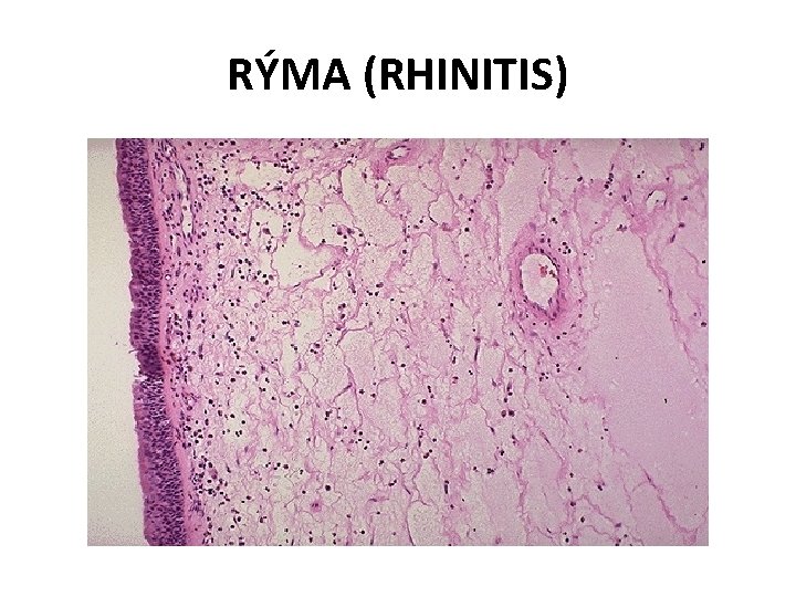 RÝMA (RHINITIS) 