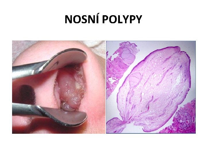 NOSNÍ POLYPY 