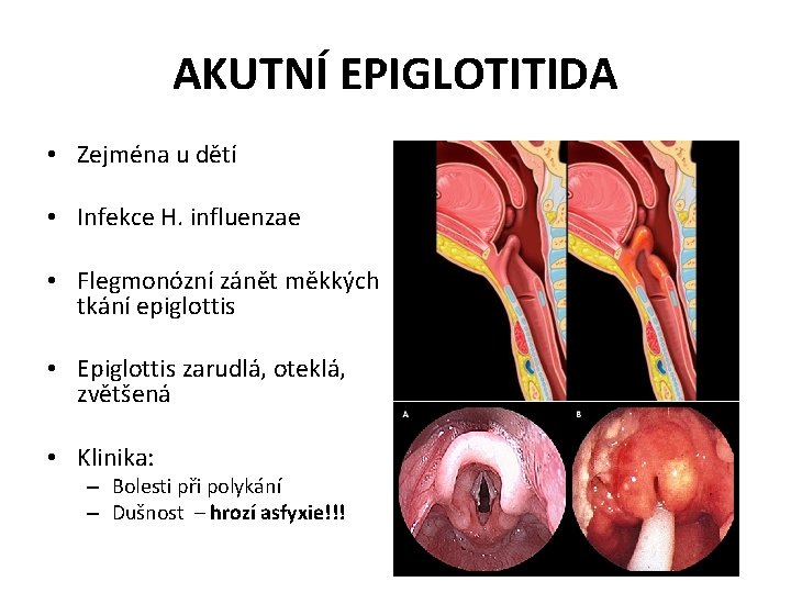 AKUTNÍ EPIGLOTITIDA • Zejména u dětí • Infekce H. influenzae • Flegmonózní zánět měkkých