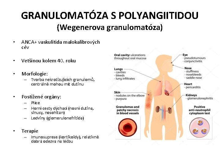 GRANULOMATÓZA S POLYANGIITIDOU (Wegenerova granulomatóza) • ANCA+ vaskulitida malokalibrových cév • Vetšinou kolem 40.