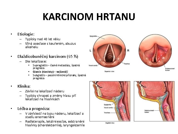 KARCINOM HRTANU • Etiologie: – Typicky nad 40 let věku – Silná asociace s