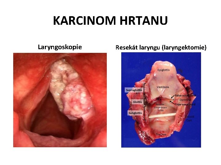 KARCINOM HRTANU Laryngoskopie Resekát laryngu (laryngektomie) 