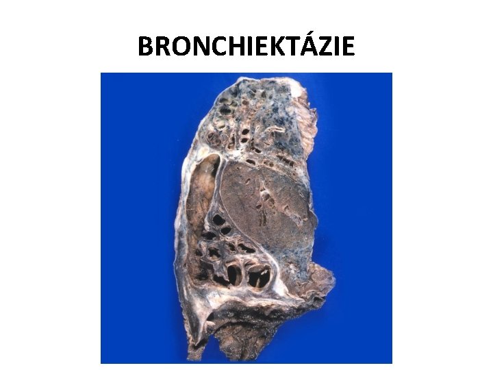 BRONCHIEKTÁZIE 