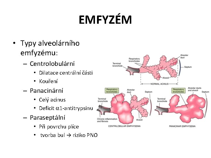 EMFYZÉM • Typy alveolárního emfyzému: – Centrolobulární • Dilatace centrální části • Kouření –