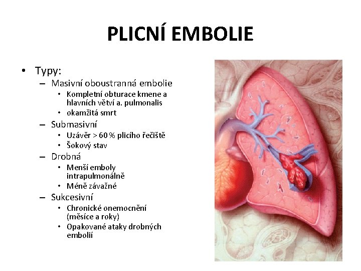 PLICNÍ EMBOLIE • Typy: – Masivní oboustranná embolie • Kompletní obturace kmene a hlavních