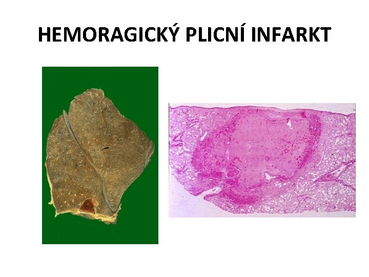 HEMORAGICKÝ PLICNÍ INFARKT 