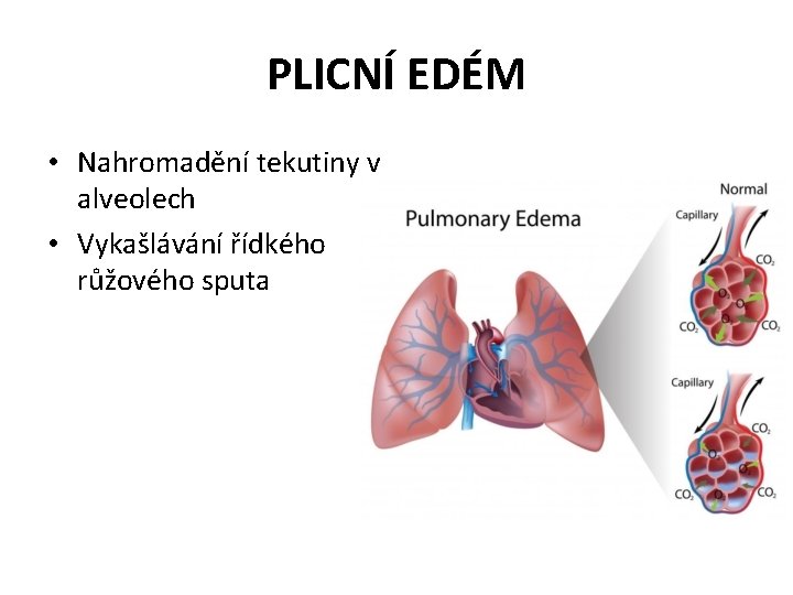 PLICNÍ EDÉM • Nahromadění tekutiny v alveolech • Vykašlávání řídkého růžového sputa 