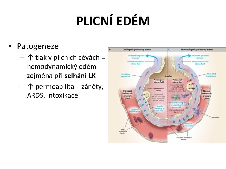 PLICNÍ EDÉM • Patogeneze: – ↑ tlak v plicních cévách = hemodynamický edém –