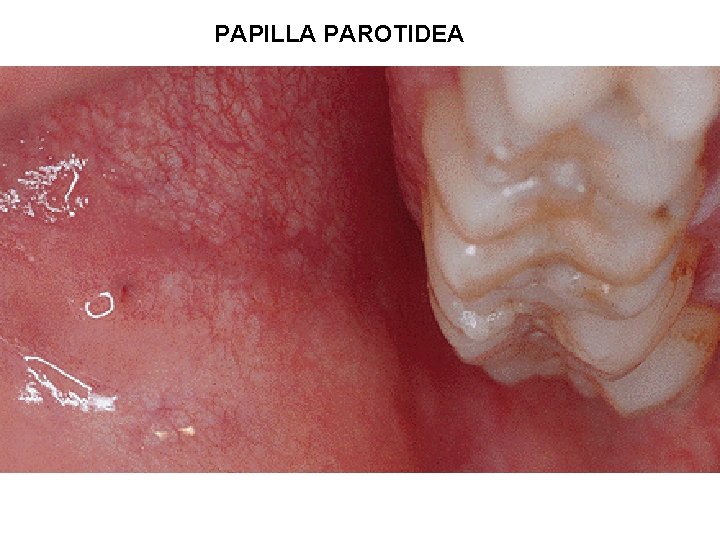PAPILLA PAROTIDEA PAPILLA PAROTIDEA