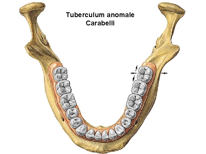 Tuberculum anomale Carabelli Tuberculum anomale Carabelli