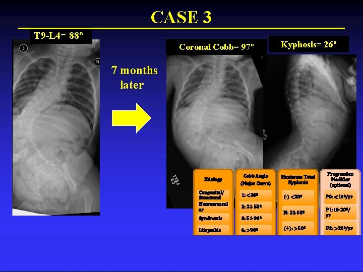 CASE 3 T 9 -L 4= 88º Coronal Cobb= 97º Kyphosis= 26º 7 months