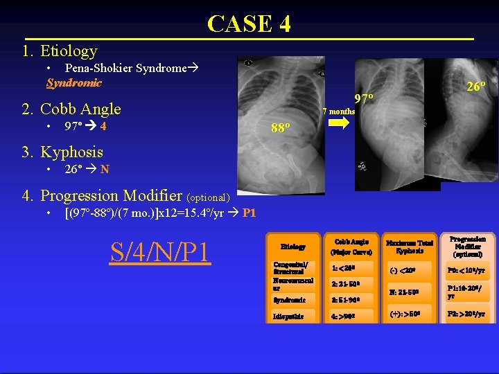 CASE 4 1. Etiology • Pena-Shokier Syndrome Syndromic 97º 2. Cobb Angle • 97º